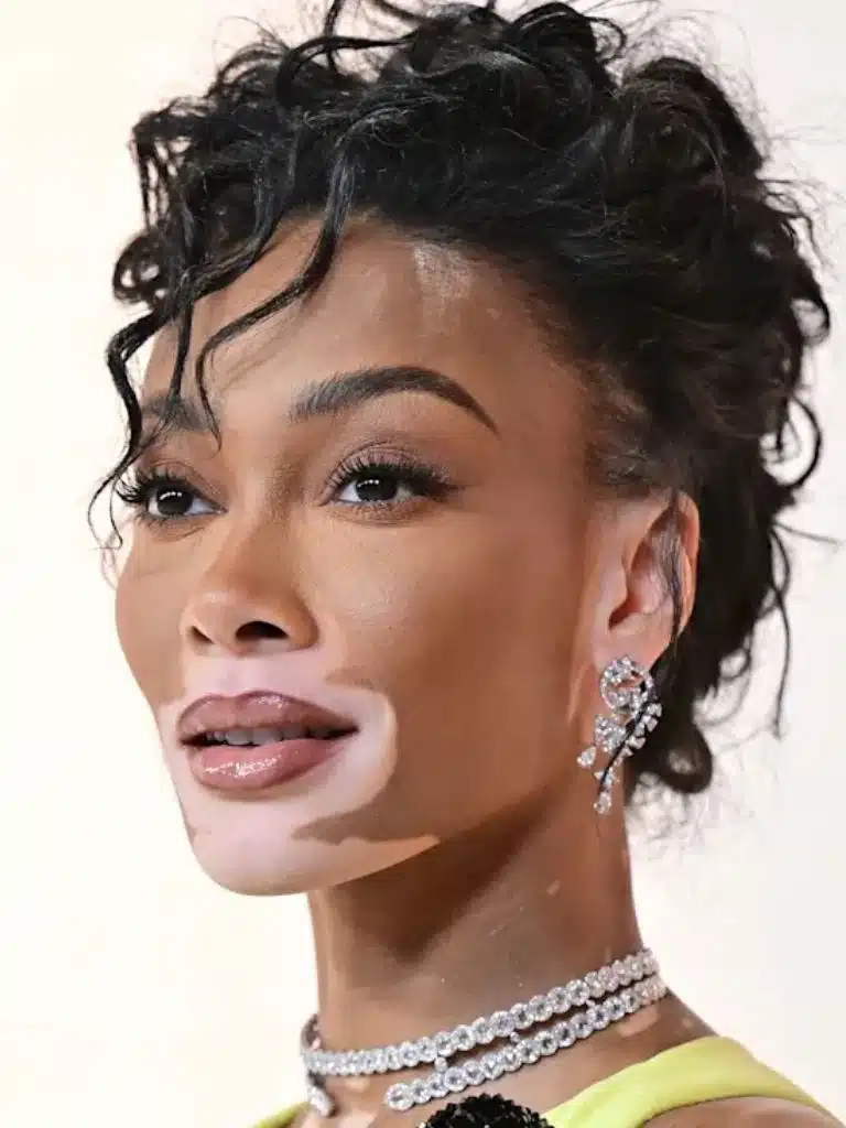 Winnie Harlow Biography: Wiki, Age, Career, Height, Weight, Boyfriend, Net Worth & More